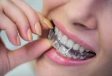Why Invisalign Is a Better Option